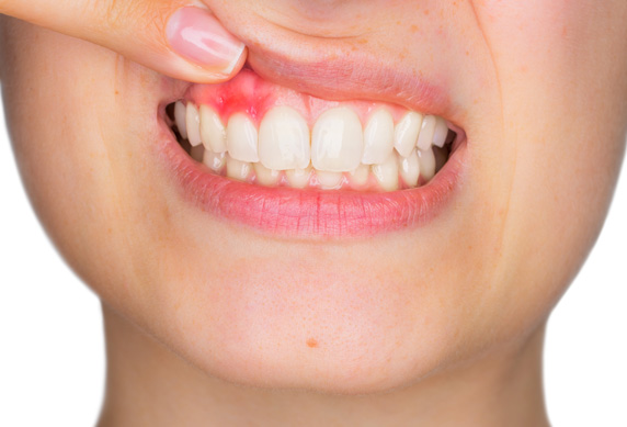 GUM DISEASE