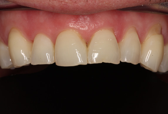 TOOTH WEAR