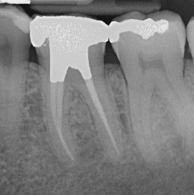 Root Canal Treatment