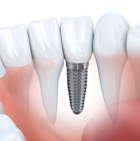 Dental Implants