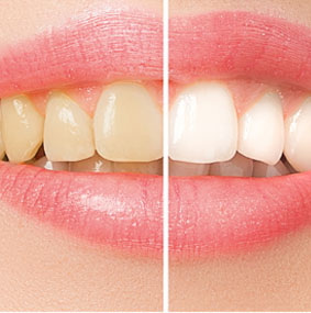 Teeth Whitening