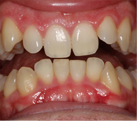 Invisalign img-1-2