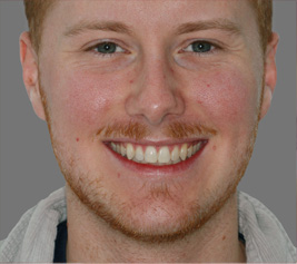 Invisalign img-1-3