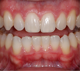 Invisalign img-1-4