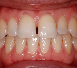 Invisalign img-2-1