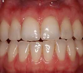 Invisalign img-2-1