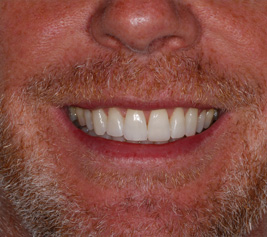 Invisalign img-3-4