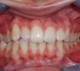 Invisalign img-4-2