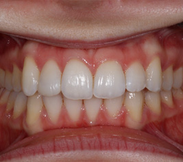 Invisalign img-4-4