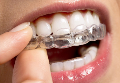 Invisalign